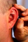 Auricular Acupuncture